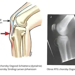 Ilustracja anatomiczna kolana i zdjęcie RTG pokazujące chorobę Osgooda-Schlattera, która może prowadzić do martwicy kolana.