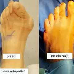 Operacja haluksa: czas zabiegu i pełna rekonwalescencja przewodnik
