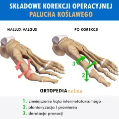 Operacja haluksa: Metody, rekonwalescencja, koszty wszystko co musisz wiedzieć