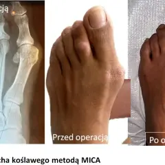 Rentgen i zdjęcia stopy przed i po operacji haluksa. Widoczna poprawa po 4 miesiącach po operacji.