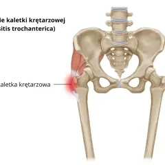 Zapalenie kaletki krętarzowej: Jakie leki naprawdę pomogą?