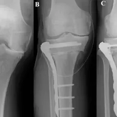 Rentgen kolana przed i po zabiegu osteotomii kości piszczelowej z użyciem płytki i śrub.