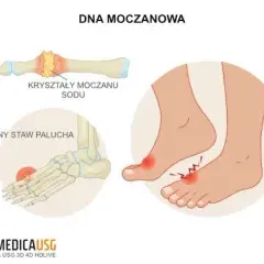 Dna moczanowa: Jak szybko i bezpiecznie zwalczyć ostry ból?