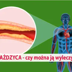 Miażdżyca: jakie leki? Statyny, nowe terapie kompleksowy przewodnik