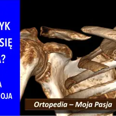 Trójwymiarowy obraz RTG ukazujący złamanie obojczyka. Czy obojczyk zawsze się zrasta? Historia nie tylko moja.