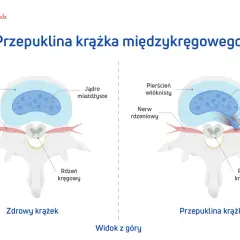Ilustracja pokazuje zdrowy krążek międzykręgowy i przepuklinę krążka, wyjaśniając, jak leczyć przepuklinę.
