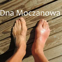 Dna moczanowa powoduje ból śródstopia. Prawa stopa jest zaczerwieniona i spuchnięta, lewa wygląda zdrowo.
