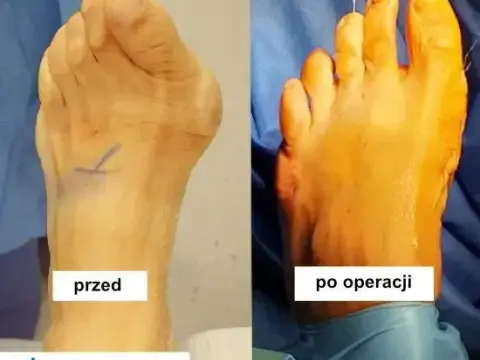 Operacja haluksa: czas zabiegu i pełna rekonwalescencja przewodnik