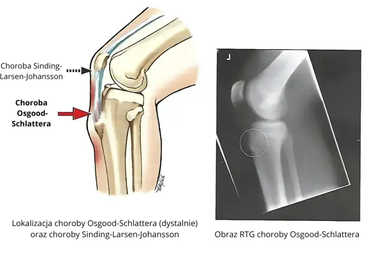 Ilustracja anatomiczna kolana i zdjęcie RTG pokazujące chorobę Osgooda-Schlattera, która może prowadzić do martwicy kolana.