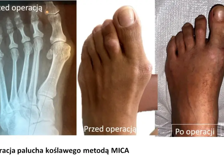 Rentgen i zdjęcia stopy przed i po operacji haluksa. Widoczna poprawa po 4 miesiącach po operacji.