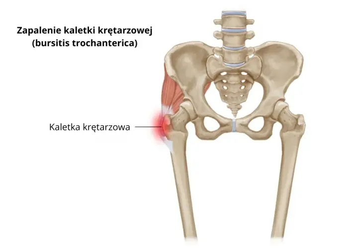 Zapalenie kaletki krętarzowej: Jakie leki naprawdę pomogą?