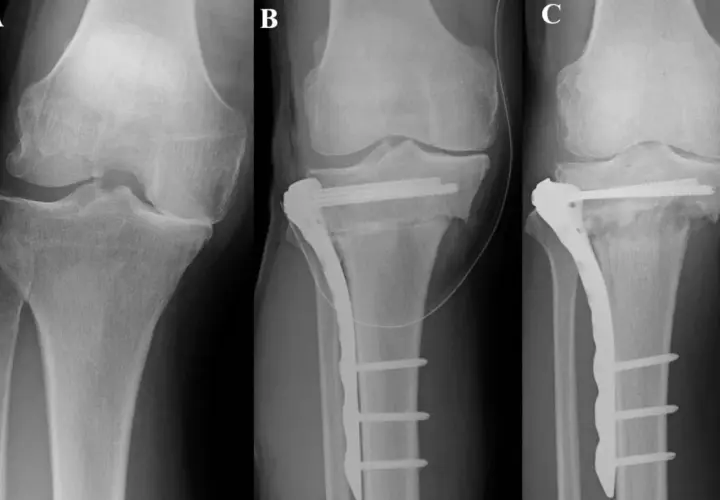 Rentgen kolana przed i po zabiegu osteotomii kości piszczelowej z użyciem płytki i śrub.