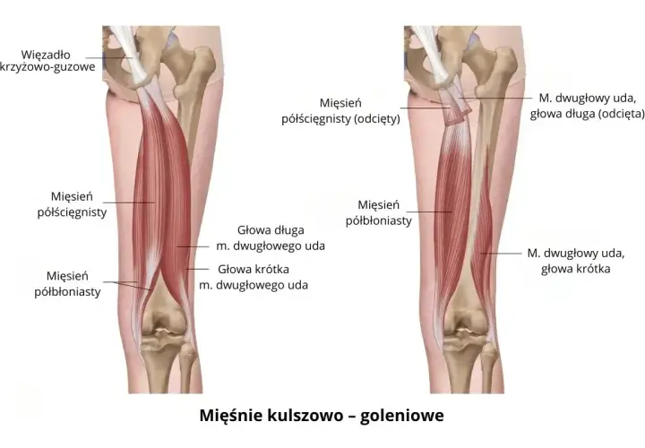 Anatomia mięśni kulszowo-goleniowych. Ilustracja pokazuje mięsień dwugłowy uda, jego głowy długą i krótką. Zapalenie mięśnia czworogłowego uda objawy mogą być podobne.