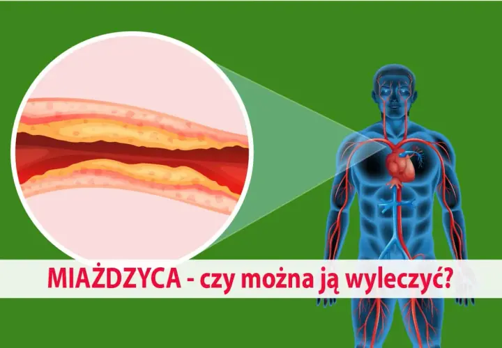 Miażdżyca: jakie leki? Statyny, nowe terapie kompleksowy przewodnik