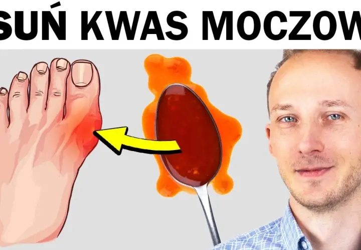 Atak dny moczanowej? Co pomoże bez recepty! Natychmiastowa ulga
