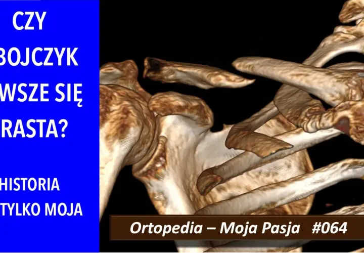Trójwymiarowy obraz RTG ukazujący złamanie obojczyka. Czy obojczyk zawsze się zrasta? Historia nie tylko moja.