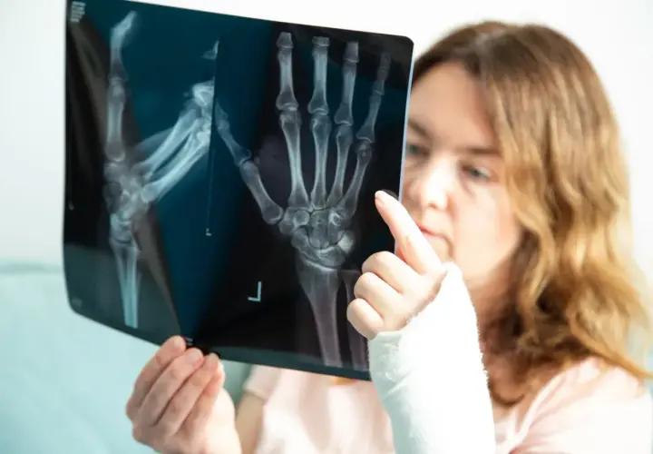 Kobieta z ręką w gipsie analizuje zdjęcie RTG, na którym widoczne jest złamanie spiralne kości.