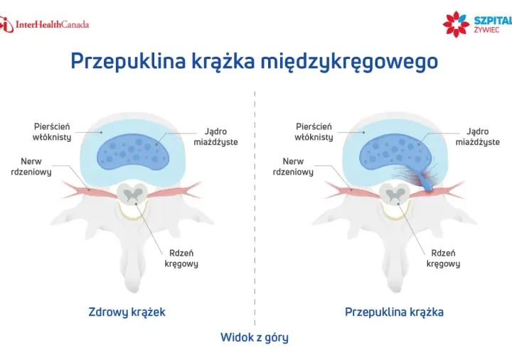 Ilustracja pokazuje zdrowy krążek międzykręgowy i przepuklinę krążka, wyjaśniając, jak leczyć przepuklinę.