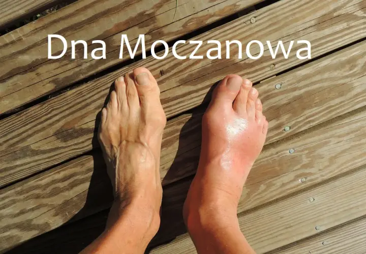 Dna moczanowa powoduje ból śródstopia. Prawa stopa jest zaczerwieniona i spuchnięta, lewa wygląda zdrowo.
