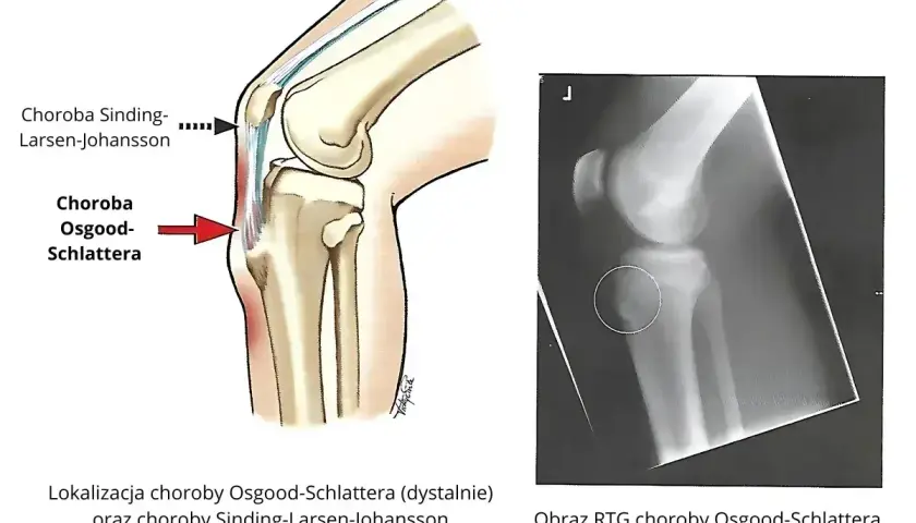 Ilustracja anatomiczna kolana i zdjęcie RTG pokazujące chorobę Osgooda-Schlattera, która może prowadzić do martwicy kolana.