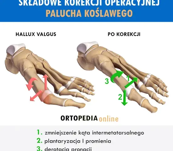 Operacja haluksa: Metody, rekonwalescencja, koszty wszystko co musisz wiedzieć