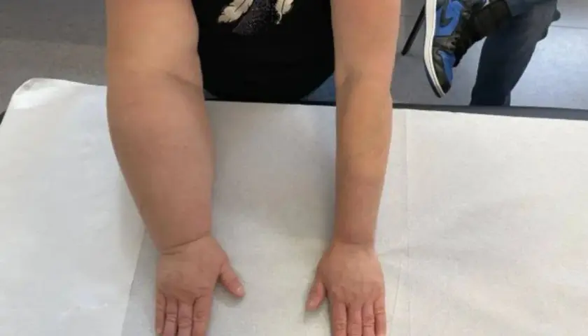 Ręka z obrzękiem limfatycznym po lewej, porównana z drugą. Ćwiczenia na obrzęk limfatyczny ręki pomagają zmniejszyć opuchliznę.