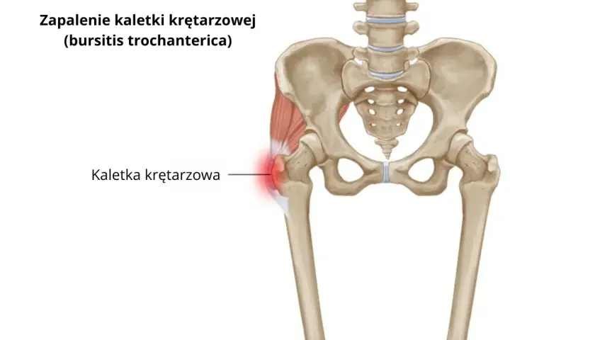 Zapalenie kaletki krętarzowej: Jakie leki naprawdę pomogą?
