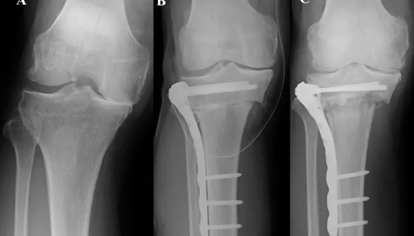 Rentgen kolana przed i po zabiegu osteotomii kości piszczelowej z użyciem płytki i śrub.