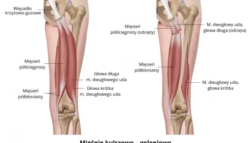Anatomia mięśni kulszowo-goleniowych. Ilustracja pokazuje mięsień dwugłowy uda, jego głowy długą i krótką. Zapalenie mięśnia czworogłowego uda objawy mogą być podobne.