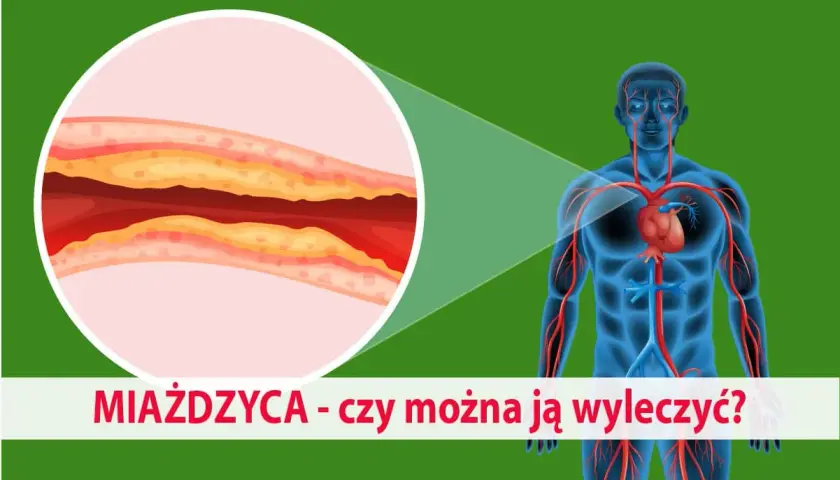 Miażdżyca: jakie leki? Statyny, nowe terapie kompleksowy przewodnik