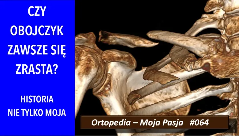 Trójwymiarowy obraz RTG ukazujący złamanie obojczyka. Czy obojczyk zawsze się zrasta? Historia nie tylko moja.