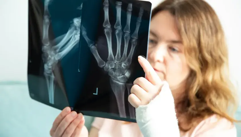 Kobieta z ręką w gipsie analizuje zdjęcie RTG, na którym widoczne jest złamanie spiralne kości.