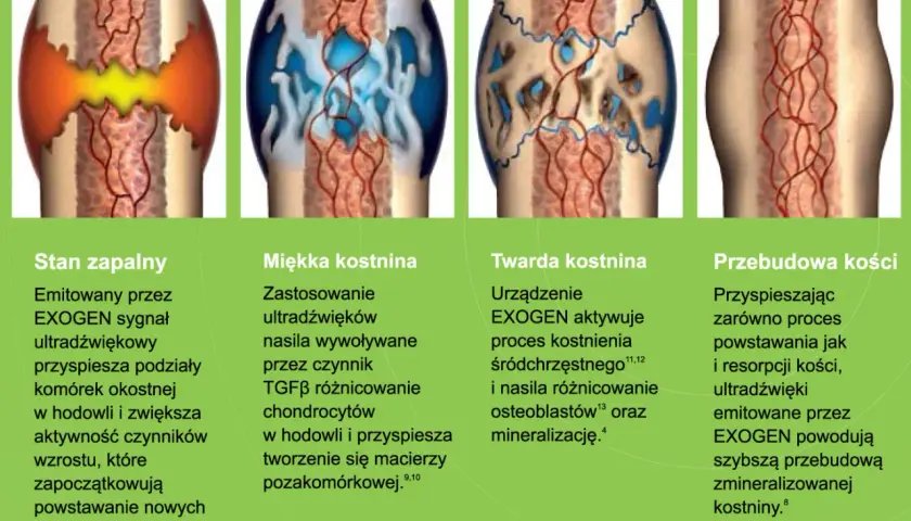 Ilustracja pokazuje etapy zrostu kości: stan zapalny, miękką i twardą kostninę, a na końcu przebudowę kości.