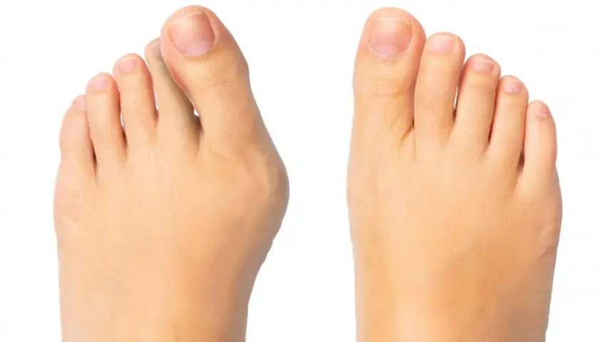 Haluksy: Jaki lekarz pomoże? Ortopeda, podolog, fizjoterapeuta