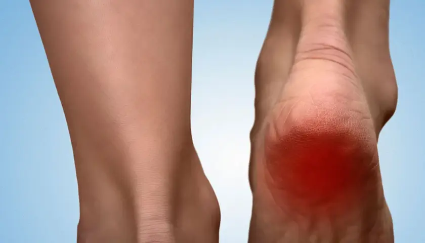 Ból pięty, zaczerwienienie i test na rozcięgno podeszwowe.