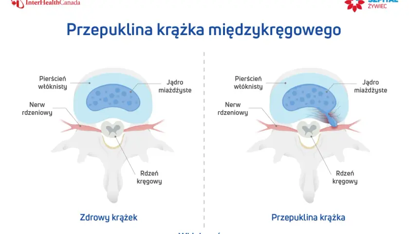Ilustracja pokazuje zdrowy krążek międzykręgowy i przepuklinę krążka, wyjaśniając, jak leczyć przepuklinę.