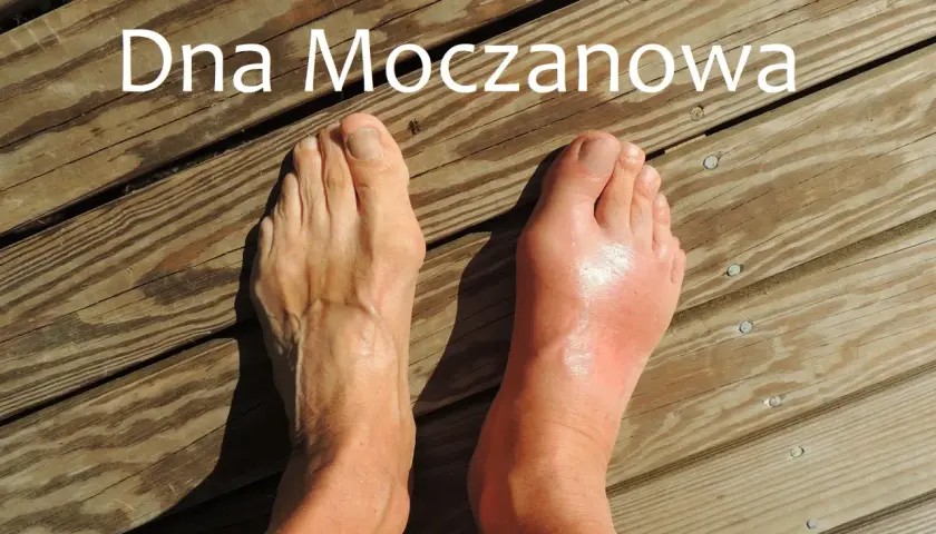 Dna moczanowa powoduje ból śródstopia. Prawa stopa jest zaczerwieniona i spuchnięta, lewa wygląda zdrowo.