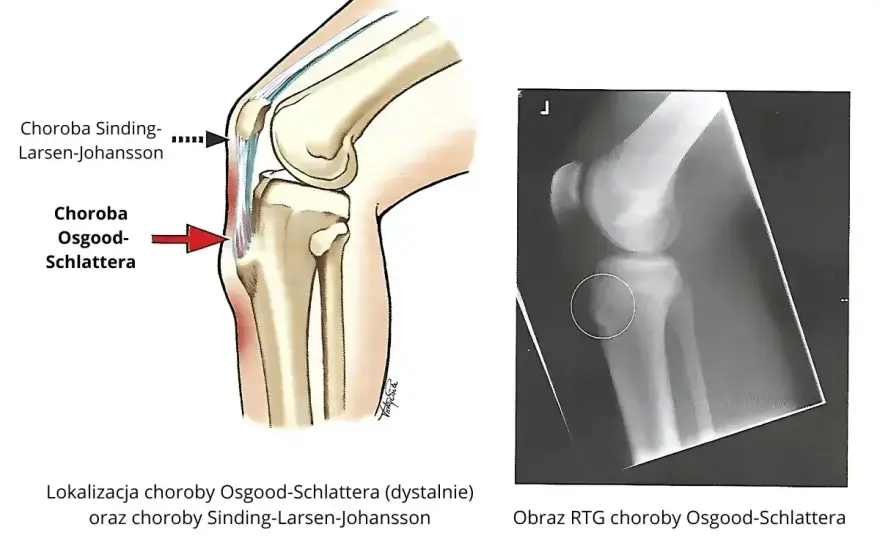 Osteonekroza kolana - objawy, MRI i kiedy potrzebny jest zabieg