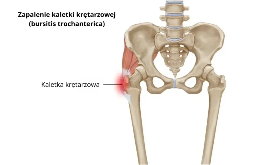 Zapalenie kaletki krętarzowej: Jakie leki naprawdę pomogą?