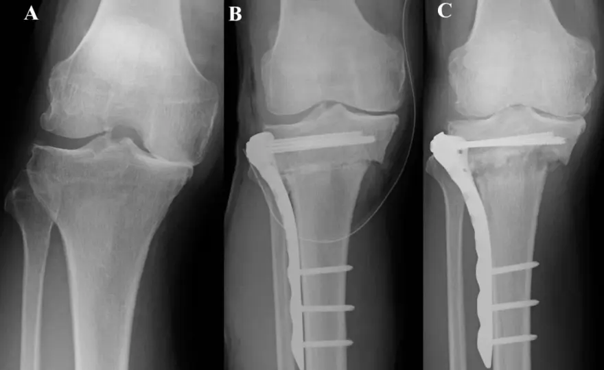Osteotomia piszczeli - kiedy ma sens i jak wygląda zabieg?