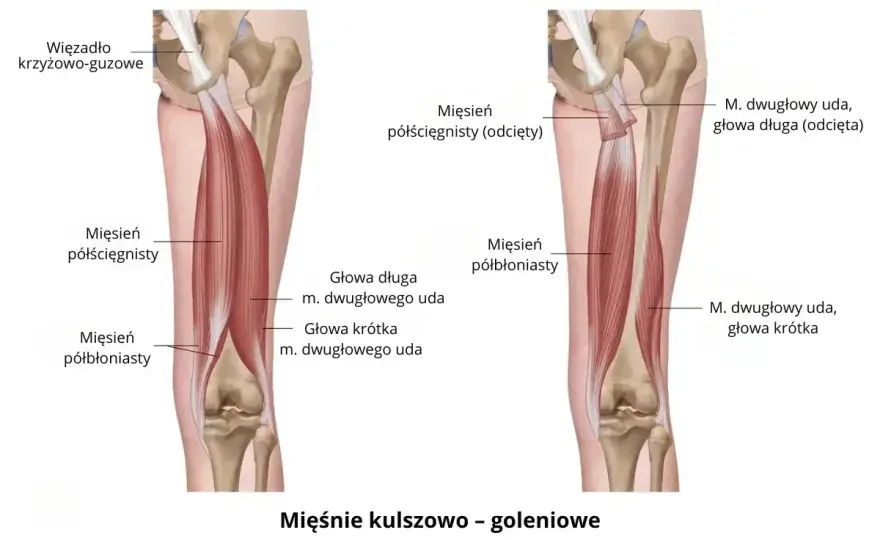 Ból mięśnia czworogłowego uda - jak rozpoznać uraz i co robić?