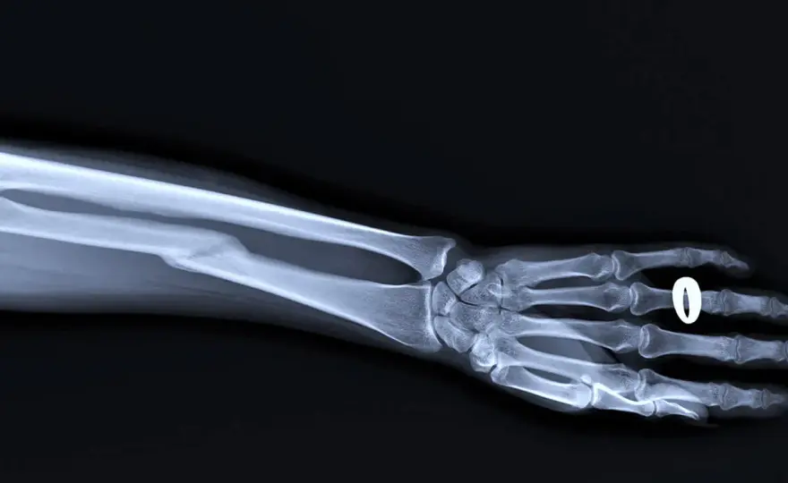 Złamanie kości promieniowej przy nadgarstku - gips czy operacja?