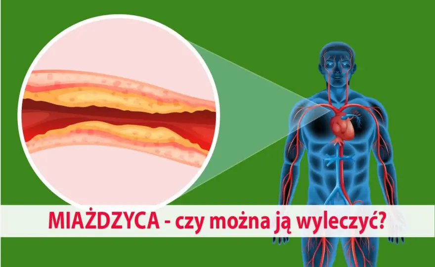 Miażdżyca: jakie leki? Statyny, nowe terapie kompleksowy przewodnik