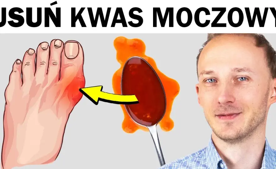 Atak dny moczanowej? Co pomoże bez recepty! Natychmiastowa ulga