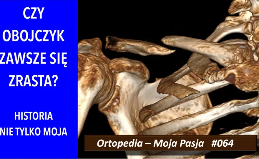 Złamanie obojczyka - kiedy wystarczy temblak, a kiedy operacja?