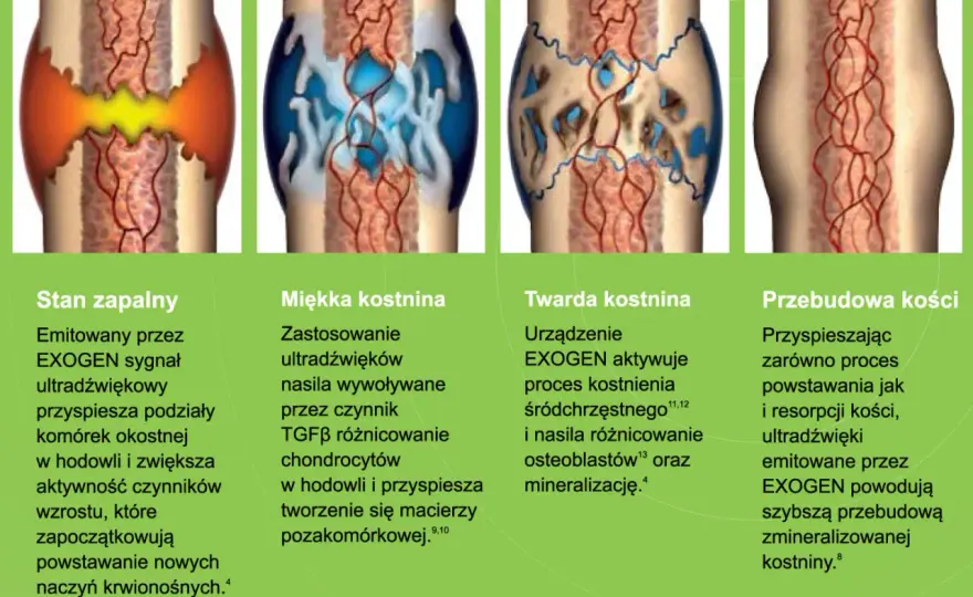 Zrost kości na RTG - jak rozpoznać prawidłowe gojenie?