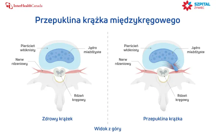 Przepuklina kręgosłupa - jak leczyć ją rozsądnie?