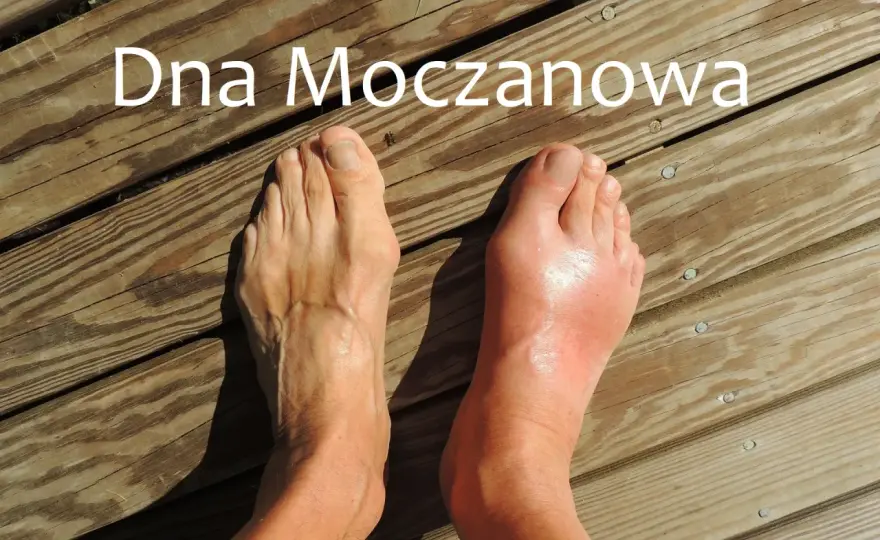 Dna moczanowa w śródstopiu - jak rozpoznać napad?