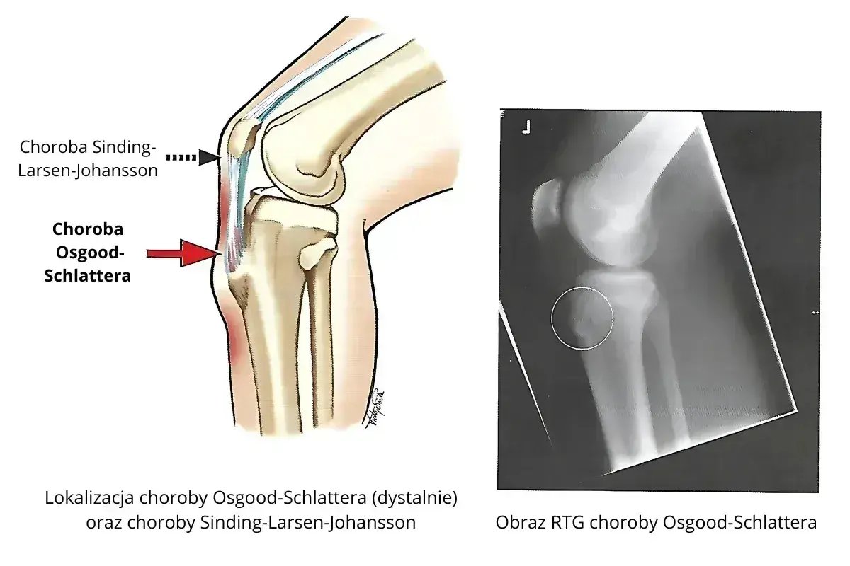 Ilustracja anatomiczna kolana i zdjęcie RTG pokazujące chorobę Osgooda-Schlattera, która może prowadzić do martwicy kolana.