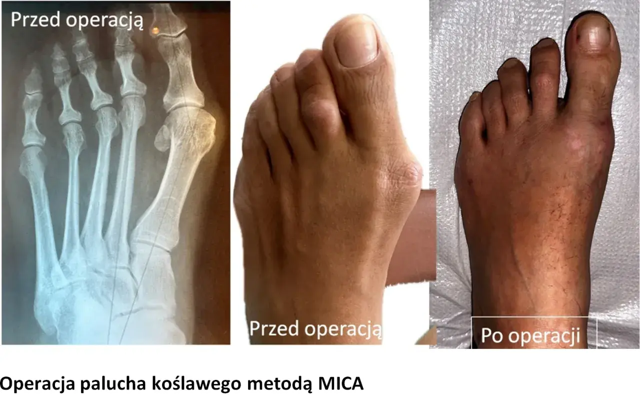 Rentgen i zdjęcia stopy przed i po operacji haluksa. Widoczna poprawa po 4 miesiącach po operacji.